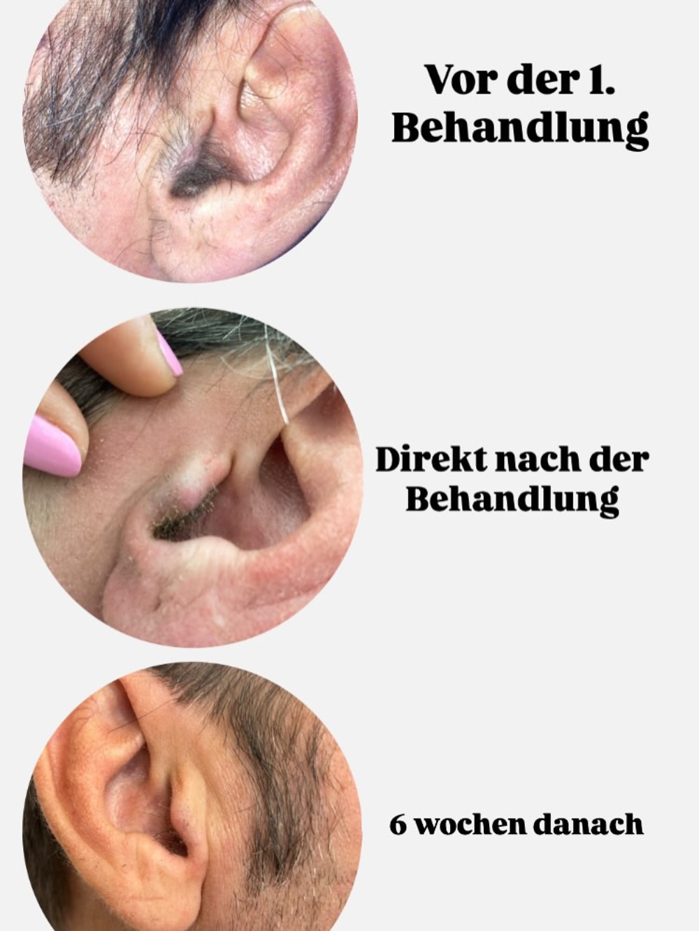 Ein Bild sagt mehr als tausend Worte:
📸 Links seht ihr den Unterschied von der ersten Behandlung bis zum Ergebnis nach nur 6 Wochen.
📌 Wichtig zu wissen:
Für eine dauerhafte Haarfreiheit sind immer mehrere Sitzungen nötig.
Warum? Haare wachsen in Zyklen – bei jeder Behandlung werden nur die Haare entfernt, die sich gerade in der aktiven Wachstumsphase befinden. Schritt für Schritt werden so immer weniger Haare nachwachsen, bis das Ergebnis dauerhaft bleibt.
🌟 Geduld + Kontinuität = Haarfreiheit 🌟
#dauerhaftehaarentfernung #hairfree #frankfurt #beauty #nohair #noworries #laserbehandlung