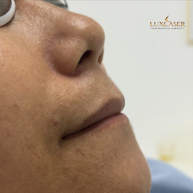 ✨ Mehr Härchen nach der Laserbehandlung?! 😳
Klingt verrückt, aber das kann wirklich passieren – man nennt es paradoxes Haarwachstum. 💡
Nach der ersten Laserbehandlung kann es vorkommen, dass feine, helle Härchen durch die Wärme des Lasers stimuliert werden und plötzlich dicker oder dunkler nachwachsen.
Das ist meist vorübergehend und kein Zeichen, dass die Behandlung nicht wirkt! 🌸
Mit weiteren Sitzungen beruhigt sich das in der Regel wieder.
Auch Hormone oder ein PCO-Syndrom können den Haarwuchs zusätzlich beeinflussen – sie machen die Haut empfindlicher auf solche Reize.
Keine Sorge, dein Körper reagiert nur – bleib dran, das Ergebnis kommt mit der Zeit. 💛