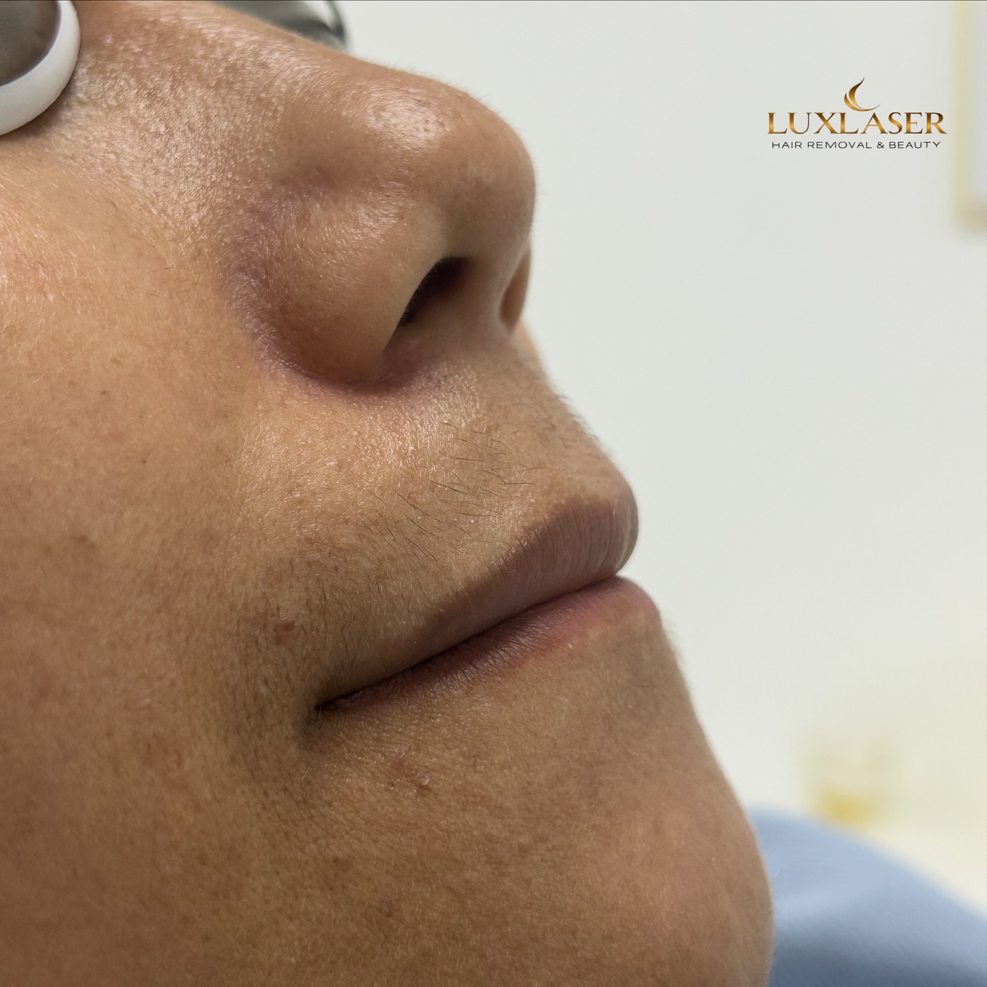 ✨ Mehr Härchen nach der Laserbehandlung?! 😳
Klingt verrückt, aber das kann wirklich passieren – man nennt es paradoxes Haarwachstum. 💡
Nach der ersten Laserbehandlung kann es vorkommen, dass feine, helle Härchen durch die Wärme des Lasers stimuliert werden und plötzlich dicker oder dunkler nachwachsen.
Das ist meist vorübergehend und kein Zeichen, dass die Behandlung nicht wirkt! 🌸
Mit weiteren Sitzungen beruhigt sich das in der Regel wieder.
Auch Hormone oder ein PCO-Syndrom können den Haarwuchs zusätzlich beeinflussen – sie machen die Haut empfindlicher auf solche Reize.
Keine Sorge, dein Körper reagiert nur – bleib dran, das Ergebnis kommt mit der Zeit. 💛