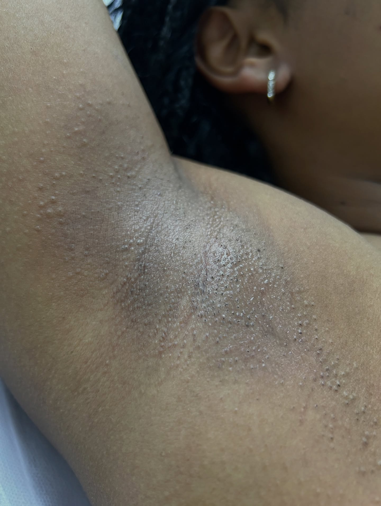 ✨ Laserbehandlung für dunkle Haut? Ja – mit dem ND:YAG Laser! ✨
Der 1064-nm ND:YAG Laser ist speziell dafür bekannt, sicher und effektiv auch bei dunkleren Hauttypen zu arbeiten.
Dank seiner tiefen Eindringtiefe wird das Melanin an der Oberfläche geschont – kein Risiko für Pigmentflecken oder Verbrennungen.
💛 Sanft. Sicher. Wirksam – auch für dunkle Haut.
#LaserHairRemoval #NDYAG #DunkleHaut #SichereBehandlung #SkincareGermany #laserbehandlung