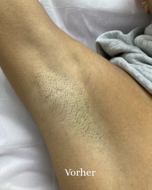 Nach 61/2 Wochen mit dem ND:YAG Laser.

•Deutlich reduziertes Haarwachstum: 
Die Haare sind sichtbar dünner, spärlicher und ungleichmäßig nachgewachsen. Viele Follikel scheinen inaktiv zu sein.

•Verlangsamtes Nachwachsen: Es sind überwiegend kurze Haarstoppeln zu sehen, was typisch für Haare ist, die sich noch in der Regenerationsphase befinden.
	
•Leichte Schattenbildung: 
Die dunkleren Punkte stammen von restlichen Haarfollikeln unter der Haut („Schatteneffekt“), was nach dieser Zeit normal ist und sich mit weiteren Sitzungen meist weiter reduziert.

💡
Die Behandlung zeigt Wirkung, ist aber noch nicht abgeschlossen – weitere Sitzungen sind nötig, um auch Haare zu erfassen, die sich zum Behandlungszeitpunkt in der Ruhephase befanden.