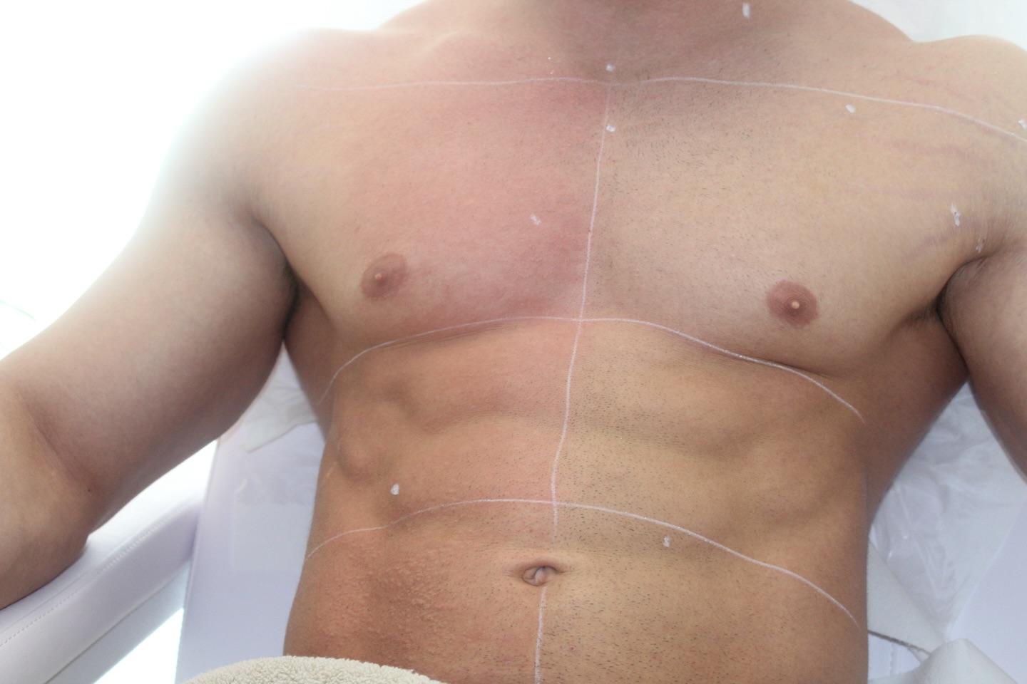 Dauerhafte Haarentfernung 🔥
Deutlich sichtbar: der Unterschied zwischen gelaserter und unbehandelter Haut.
Die Quaddeln auf der behandelten Seite sind eine normale Reaktion und zeigen, dass der Laser gezielt an den Haarfollikeln arbeitet.

Die weißen Markierungen sorgen für maximale Präzision – für ein gleichmäßiges Ergebnis ohne Lücken.

✨ Effektiv. Präzise. Professionell. ☝🏽