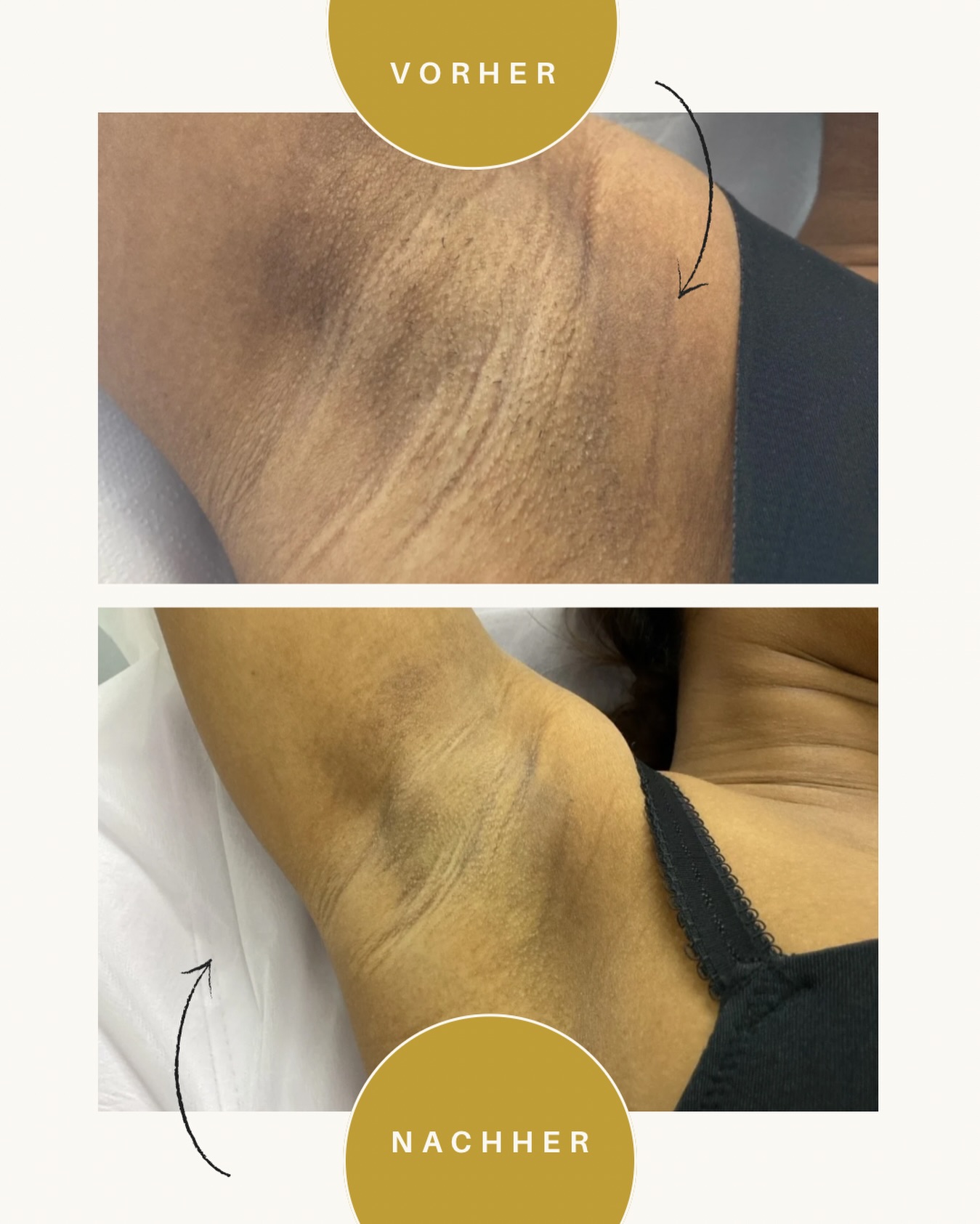 ✨ Ergebnis nach nur 2 Laserbehandlungen mit dem ND:YAG Laser für Dunkle Hauttypen ☺️ ✨

Auf den Bildern seht ihr Vorher / Nachher – und das bereits nach nur zwei Sitzungen.
Das Haarwachstum ist sichtbar reduziert, die Haut wirkt ruhiger, gleichmäßiger und gepflegter.

Wichtig zu wissen:
•Haare wachsen in Zyklen, deshalb sind mehrere Behandlungen notwendig

•Jede Haut- und Haarstruktur reagiert individuell

•Mit jeder Sitzung werden die Haare feiner und weniger

Dieses Ergebnis zeigt, wie effektiv die Laserbehandlung schon nach kurzer Zeit sein kann. 💛
Für ein langfristig glattes Ergebnis empfiehlt sich eine vollständige Behandlungsserie.

📩 Bei Fragen oder für eine persönliche Beratung melde dich gerne bei mir.